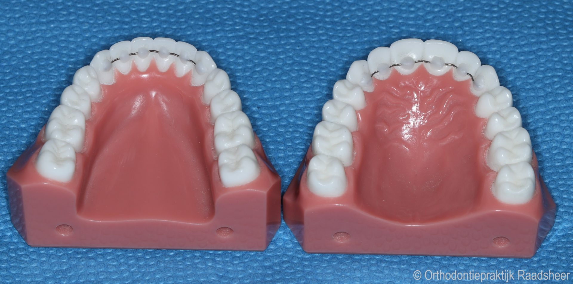 Na de orthodontische behandeling Orthodontiepraktijk Raadsheer